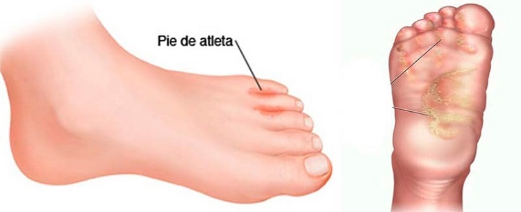 pie de atleta
